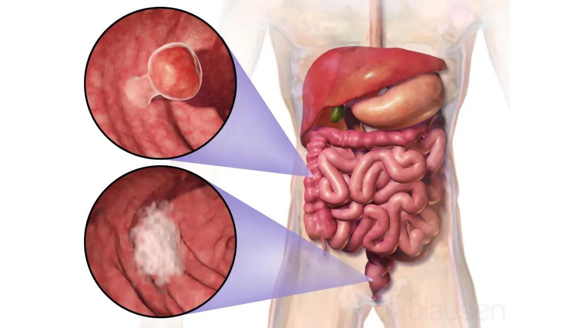 How Often Need Colonoscopy colorectal cancer illustration showing a tumor within the colon.