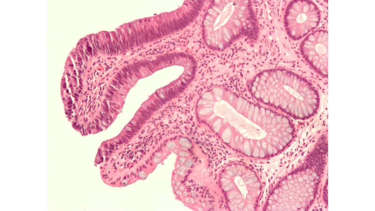 How Often Need Colonoscopy tubular adenoma micrograph showing an adenomatous colon polyp removed during colonoscopy.