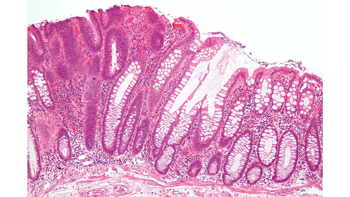 How Often Need Colonoscopy intermediate tubular adenoma micrograph showing colon polyp tissue changes.