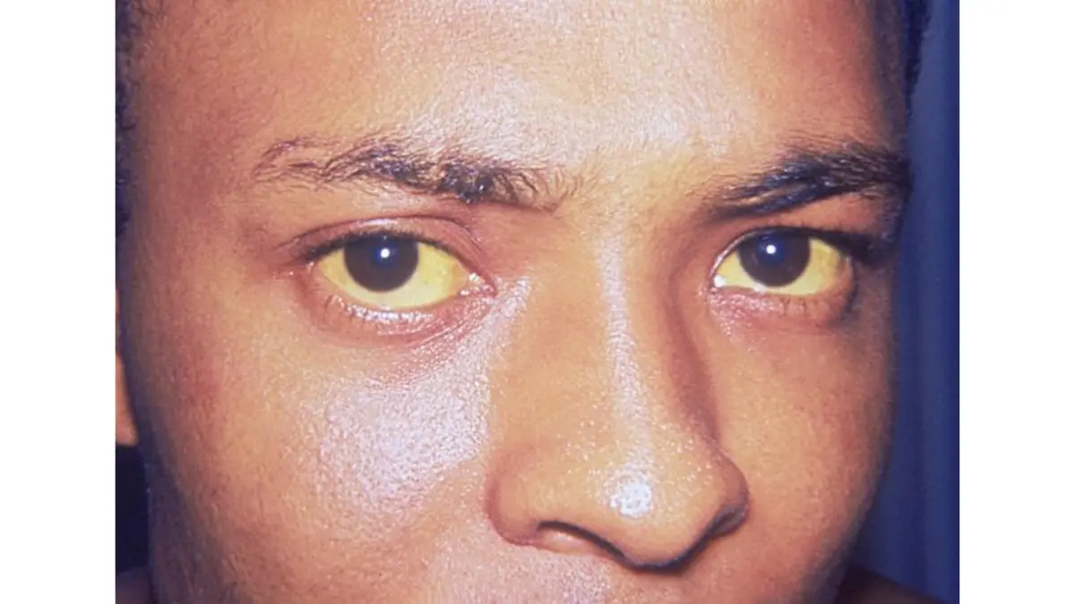 Clinical close-up image showing jaundice and distinct scleral icterus yellowing of the eye, an early symptom for Black Americans.