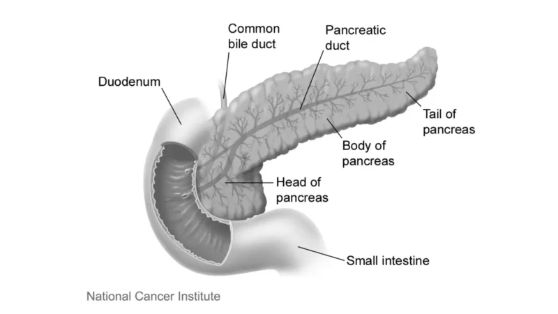 Jaundice anatomical diagram showing pancreas head, body, tail, common bile duct, duodenum, and small intestine