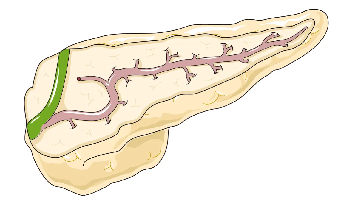 Medical drawing of the pancreas and pancreatic duct to visualize anatomy related to New-Onset Diabetes warning signs.