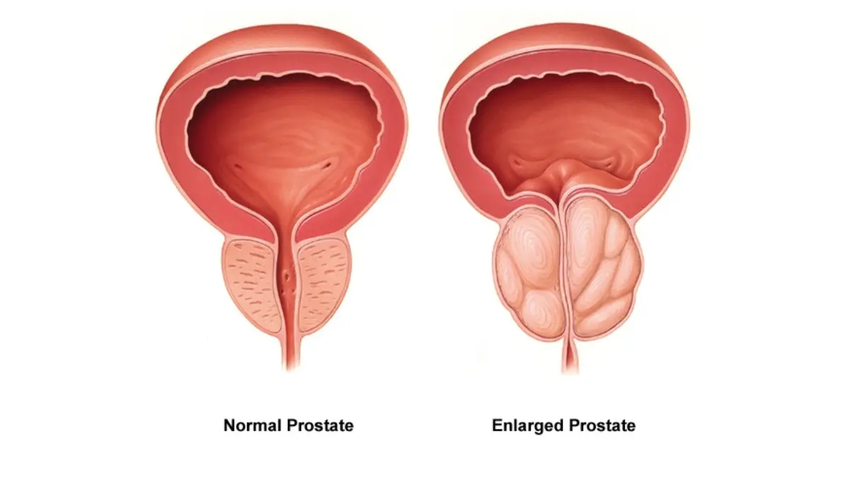 Medical illustration comparing a healthy normal prostate to an enlarged prostate with BPH, the most common benign reason for a high PSA
