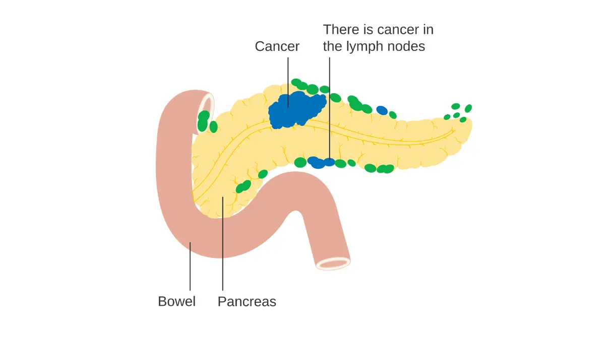 pancreatic cancer stage lymph node spread illustration showing N staging in pancreatic cancer
