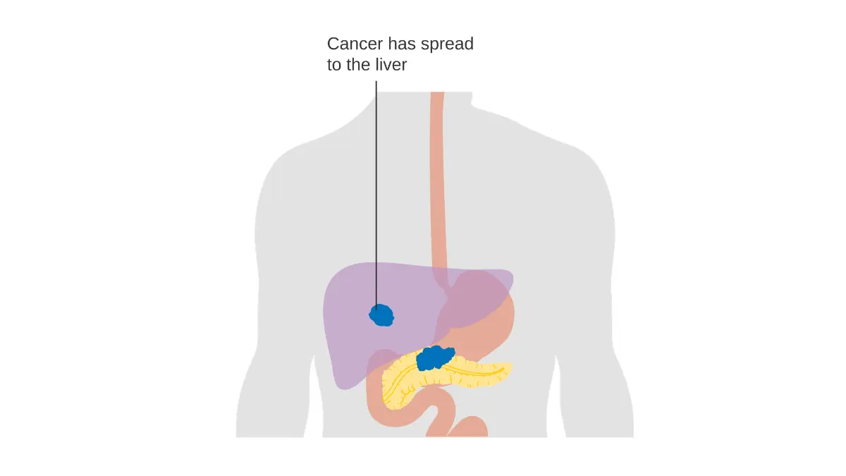 pancreatic cancer stage metastatic spread illustration showing M staging and distant organ spread