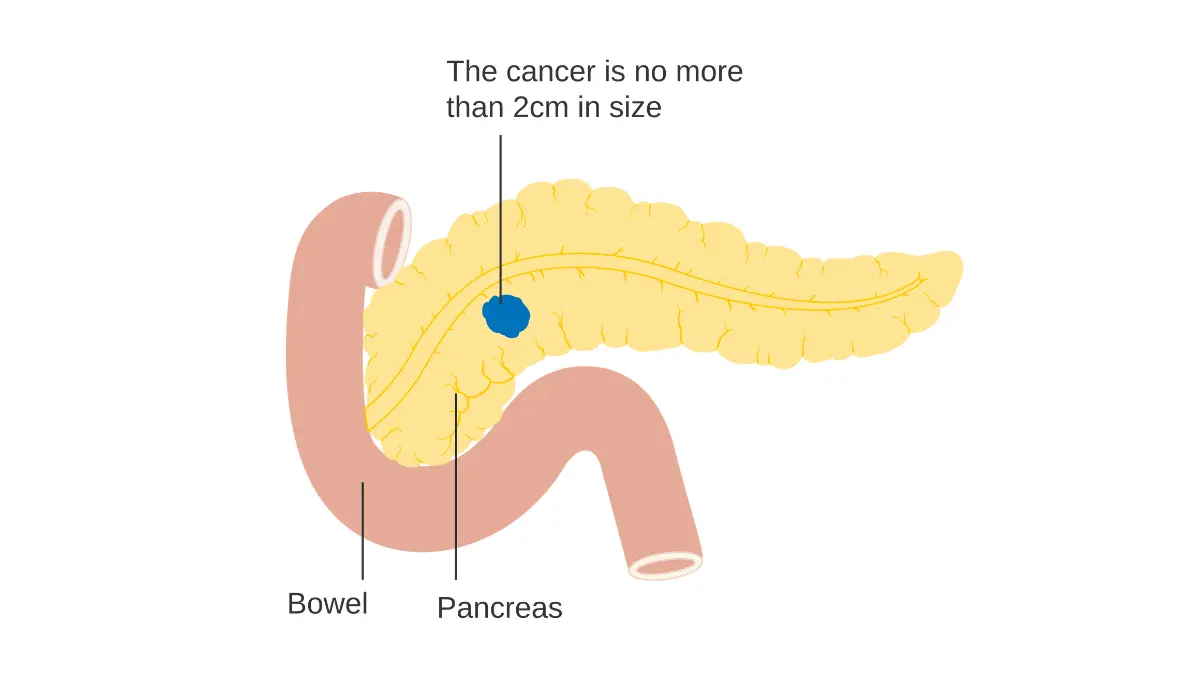 Pancreatic cancer staging diagram showing an early localized tumor confined to the pancreas.