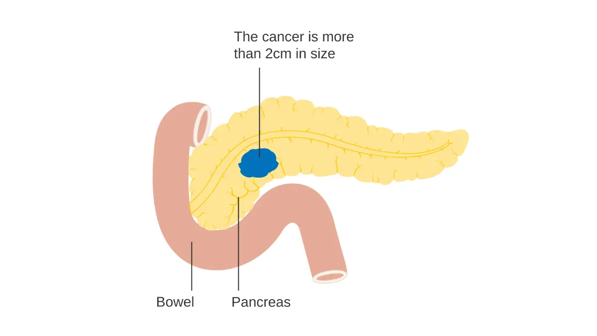 pancreatic cancer stage T2 tumor illustration showing an early localized pancreatic cancer stage