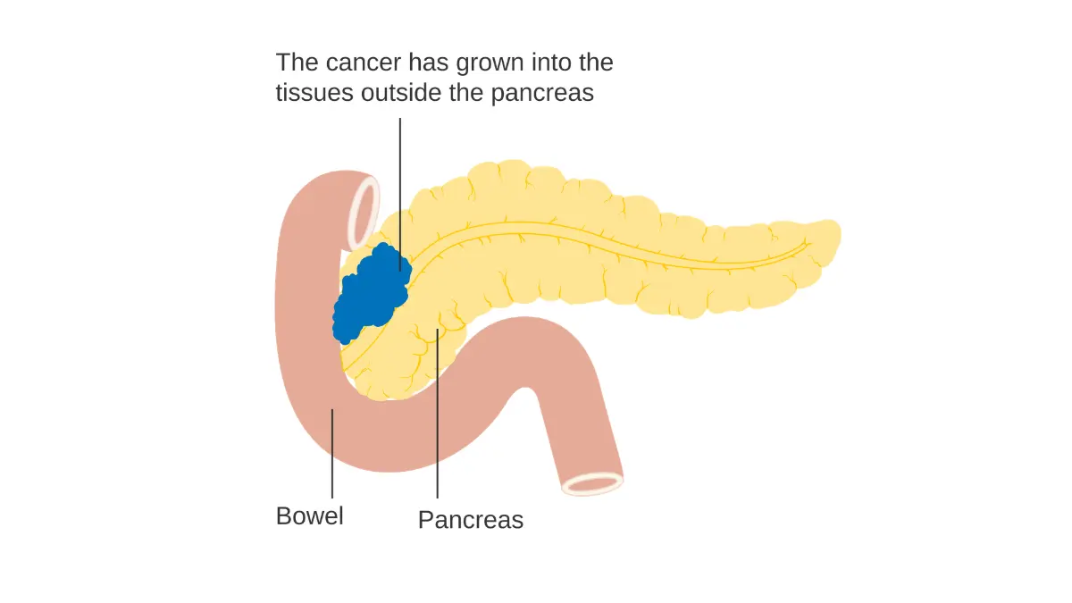 pancreatic cancer stage T3 illustration showing locally advanced pancreatic cancer