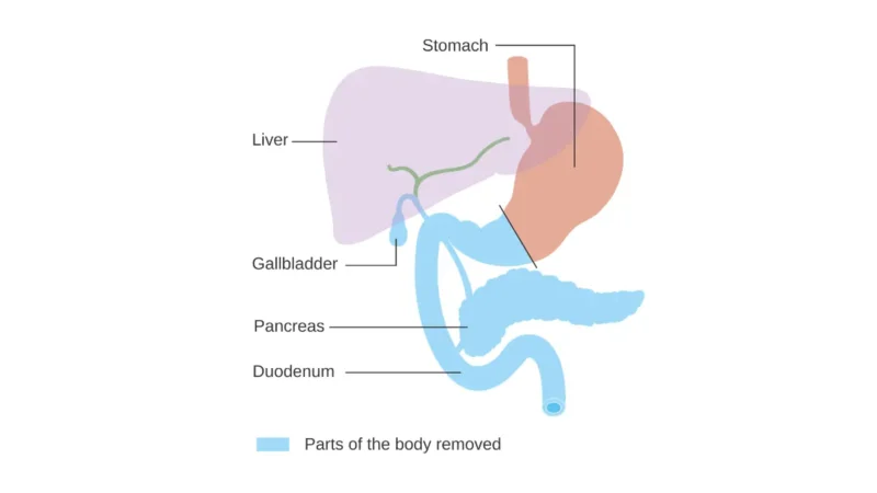 Pancreatic Cancer Treatment surgical illustration showing the area removed in total pancreatectomy.