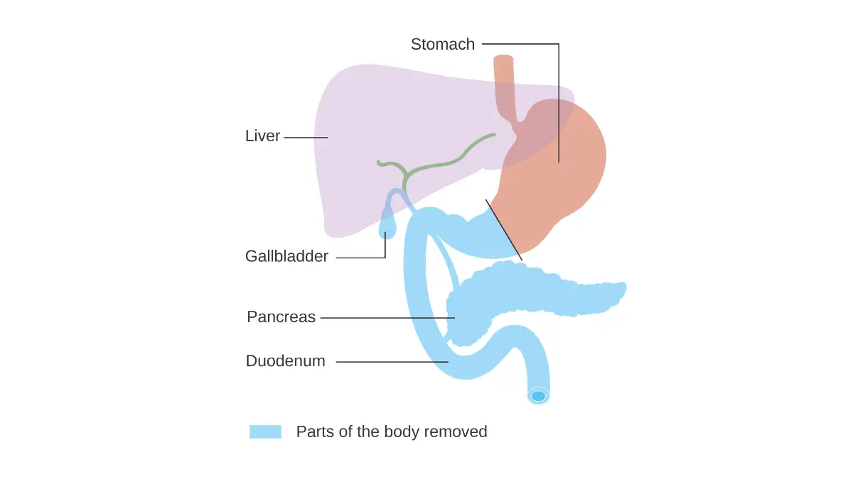 Pancreatic Cancer Treatment surgical illustration showing the area removed in total pancreatectomy.