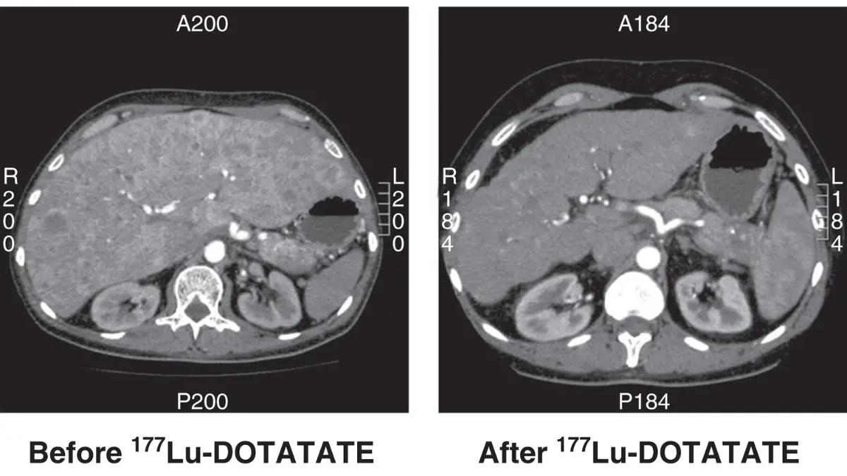 Longitudinal CT scan comparison documenting treatment efficacy on a non-functioning advanced pancreatic neuroendocrine tumor.