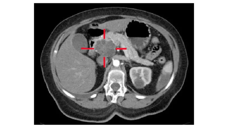 Pancreatitis duct anatomy illustration showing the pancreatic duct and common bile duct