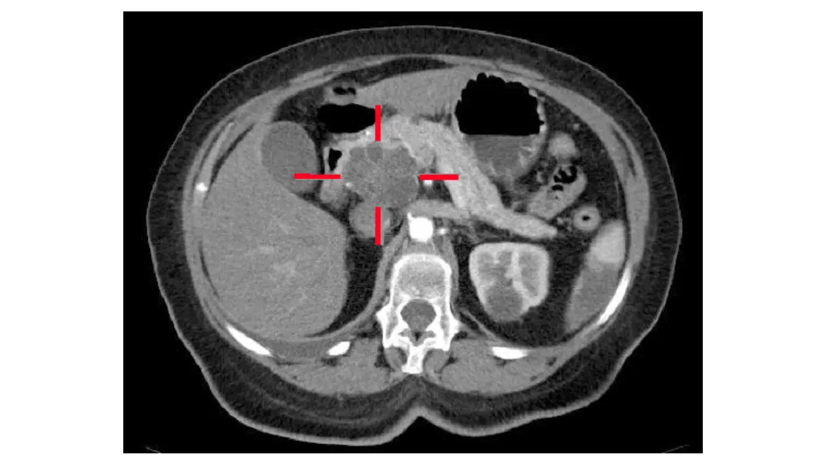 Pancreatitis duct anatomy illustration showing the pancreatic duct and common bile duct