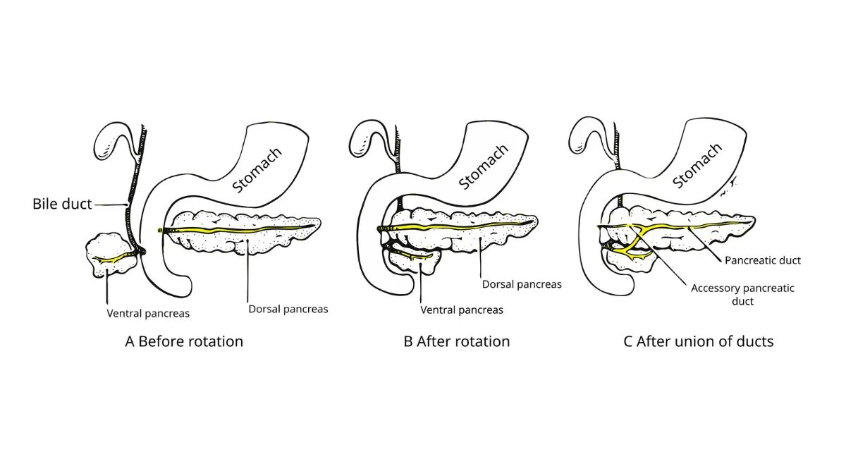 Pancreatitis differential diagnosis CT image showing a pancreatic head tumor