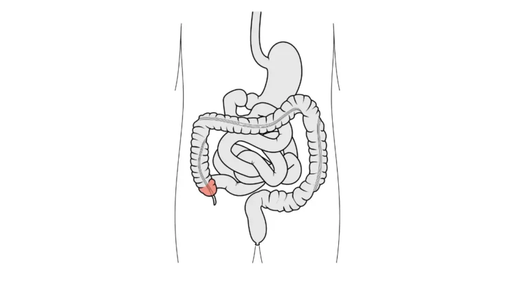 Anatomy diagram of the cecum and ileocecal valve for a Parent Prep for a Colonoscopy, showing where the small and large intestines meet.
