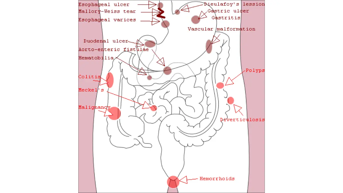 Positive Cologuard causes of bleeding diagram showing possible gastrointestinal sources behind a positive stool test.