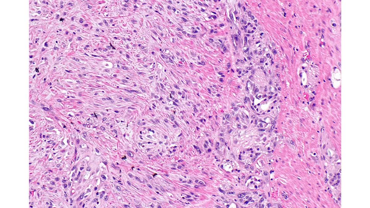 Intermediate magnification histology micrograph of prostate carcinoma tissue examined following a prostate biopsy procedure.