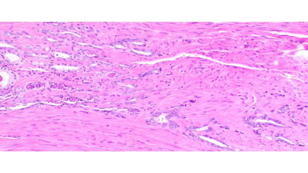 Microscopic histology image of prostate tissue sections relevant to prostate biopsy pathology analysis and Gleason grading.