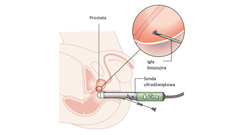 Medical vector diagram illustrating a prostate biopsy procedure with anatomical needle placement and prostate labeling for patient education.