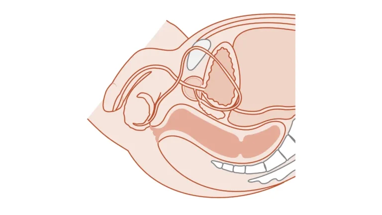 Medical cross-section diagram of the male genitourinary system showing the prostate, bladder, and urethra for a prostate cancer caregiver.