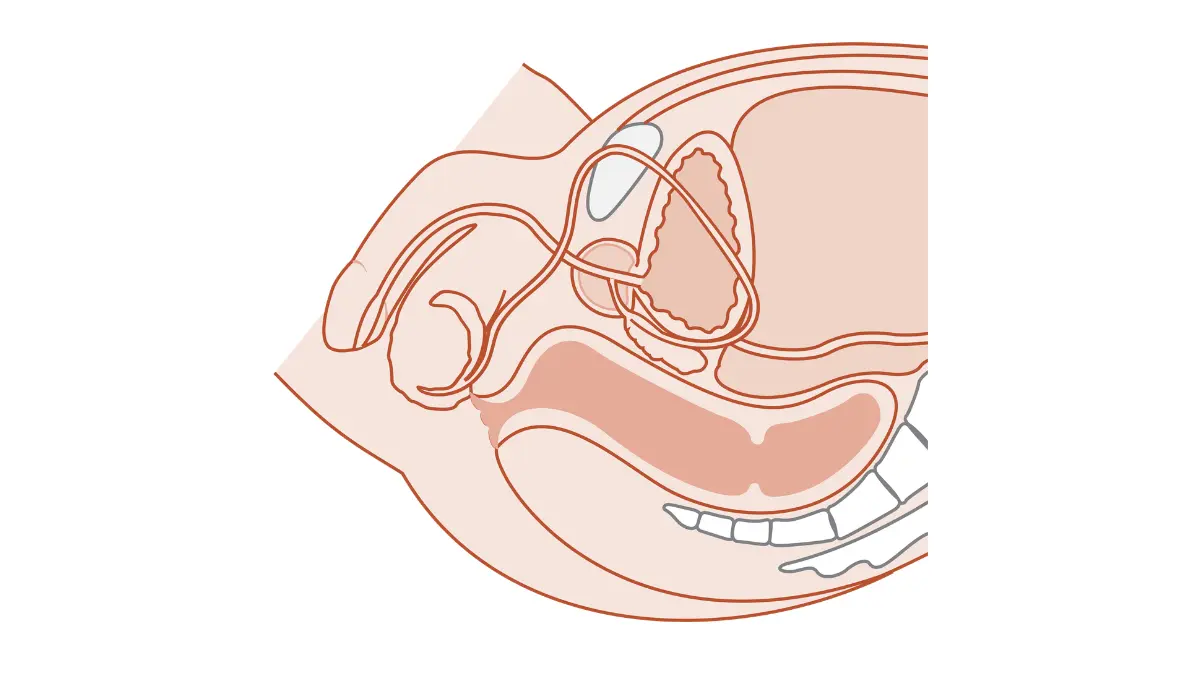 Medical cross-section diagram of the male genitourinary system showing the prostate, bladder, and urethra for a prostate cancer caregiver.
