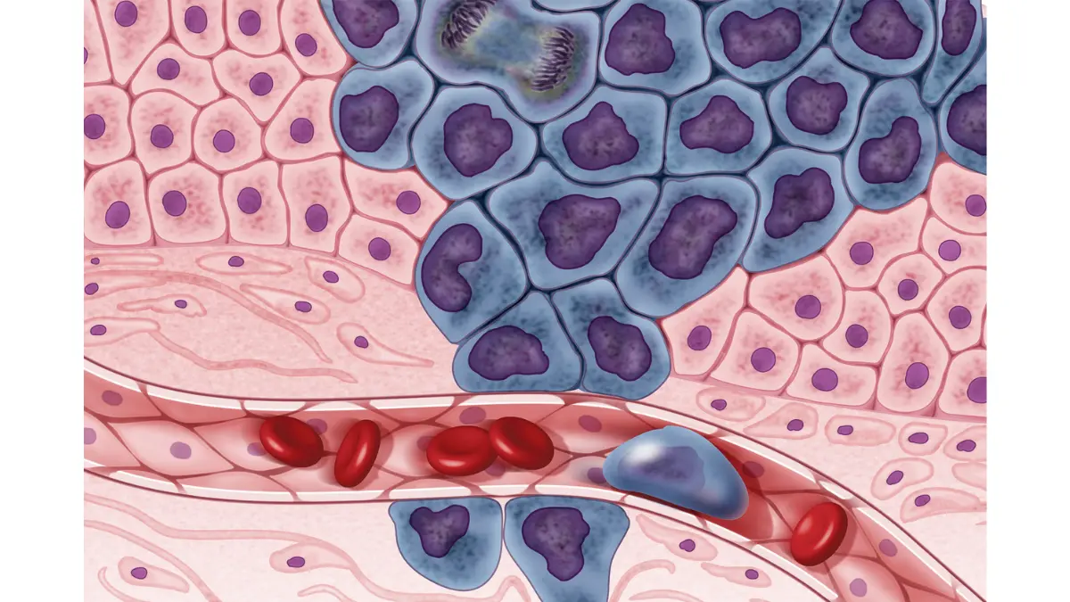prostate cancer clinical trial illustration showing cancer cell growth and metastasis through the circulatory system