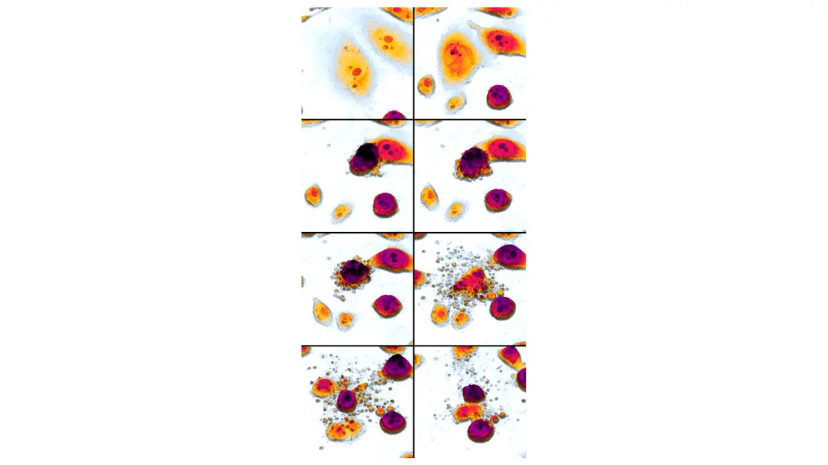 prostate cancer clinical trial laboratory research showing DU145 prostate cancer cell apoptosis after etoposide treatment