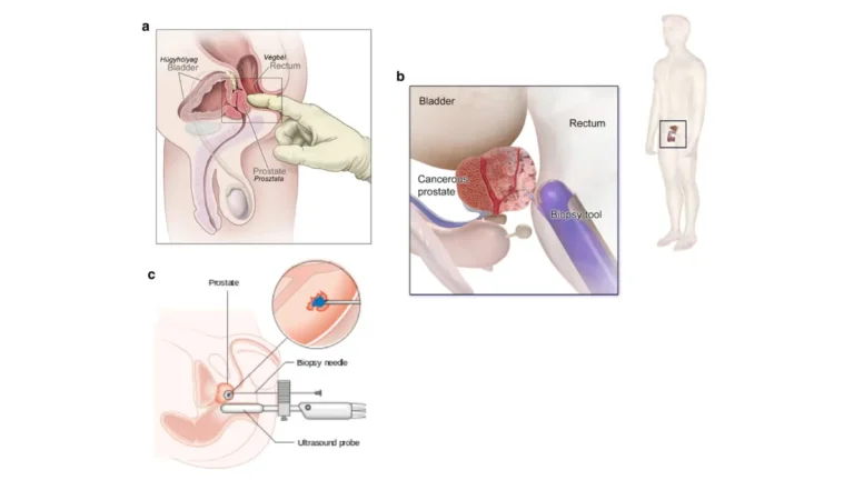 prostate cancer clinical trial diagnostic pathway showing medical evaluation and staging steps for patient eligibility