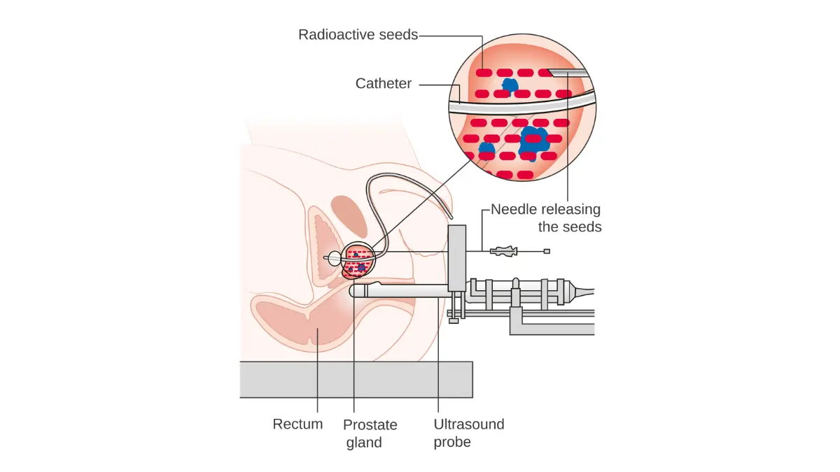 Prostate cancer recurrence treatment illustration showing radioactive seed implant placement used in prostate-directed radiation therapy.