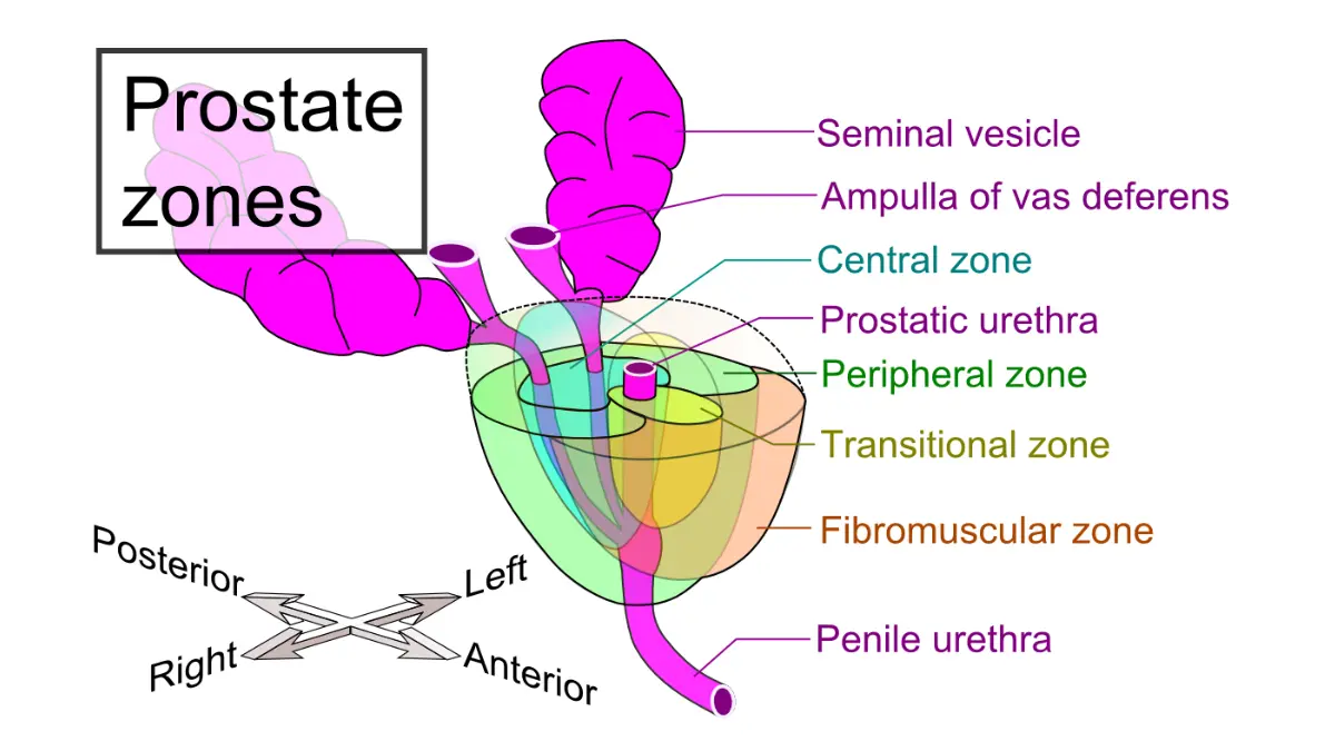 Prostate cancer recurrence zonal anatomy illustration showing the prostate zones and where disease can be discussed in relation to local recurrence.