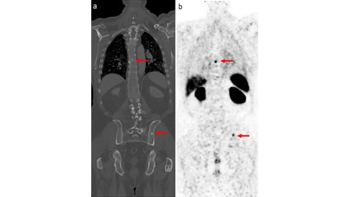 Prostate cancer recurrence PSMA PET scan image showing radiotracer uptake used to help localize recurrent prostate cancer.