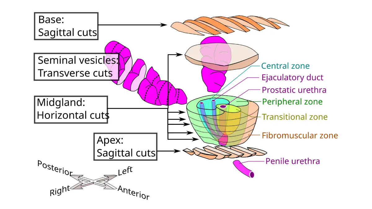 prostate cancer stages cross section illustration of the prostate showing internal anatomy.
