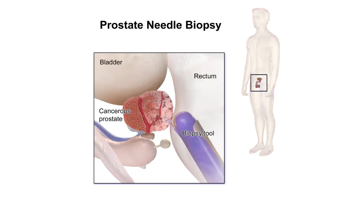 prostate cancer stages needle biopsy illustration showing how prostate tissue is sampled for grading.
