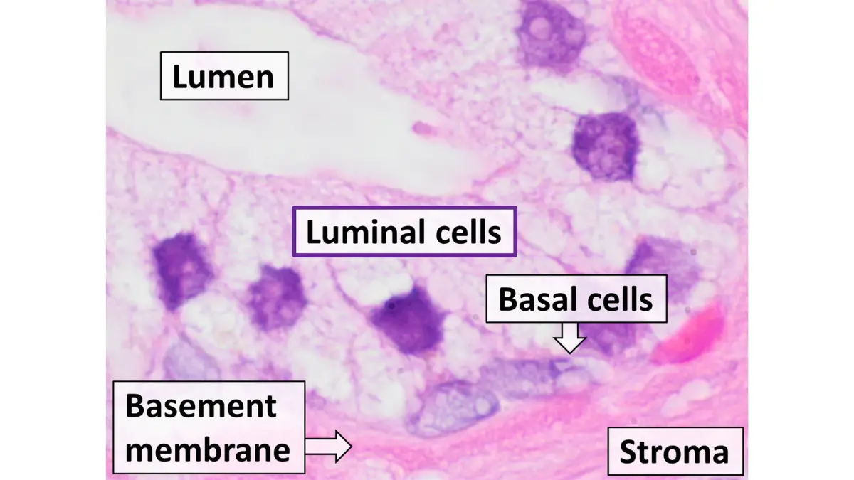 Prostate cancer statistics microanatomy diagram showing prostate gland tissue layers and cellular structure.