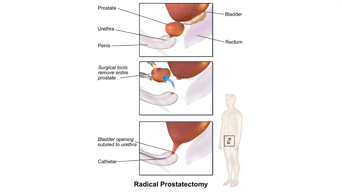 Prostate Cancer Surgery prostate removal illustration for treatment decision making