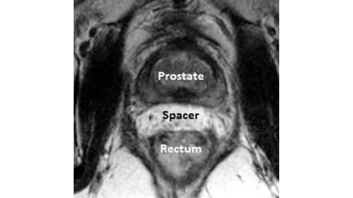 Prostate Cancer Surgery prostate spacer illustration related to radiation side effect protection