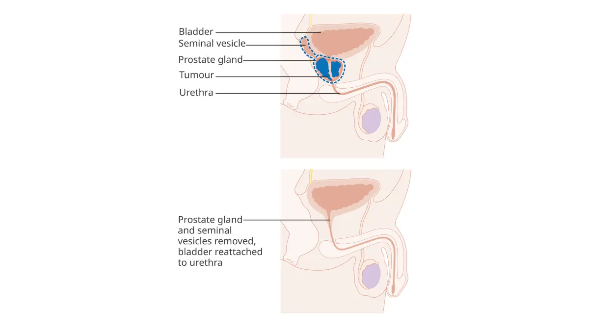 Prostate Cancer Surgery before and after radical prostatectomy anatomy diagram