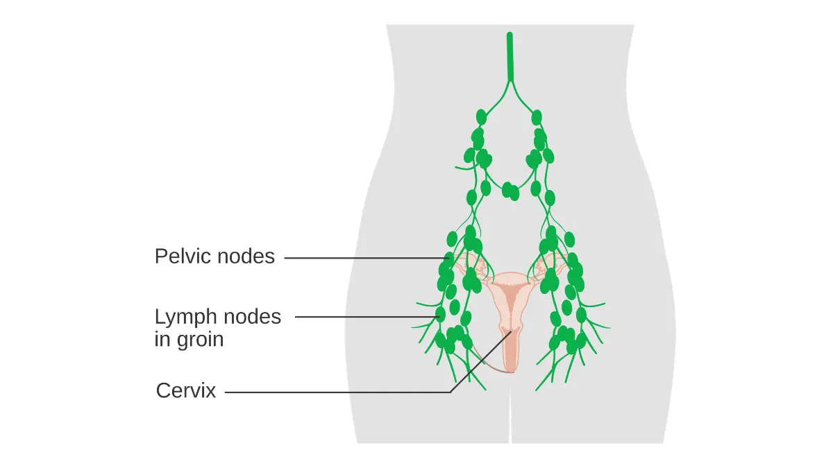 Pelvic lymph nodes diagram related to regional stage prostate cancer survival rate