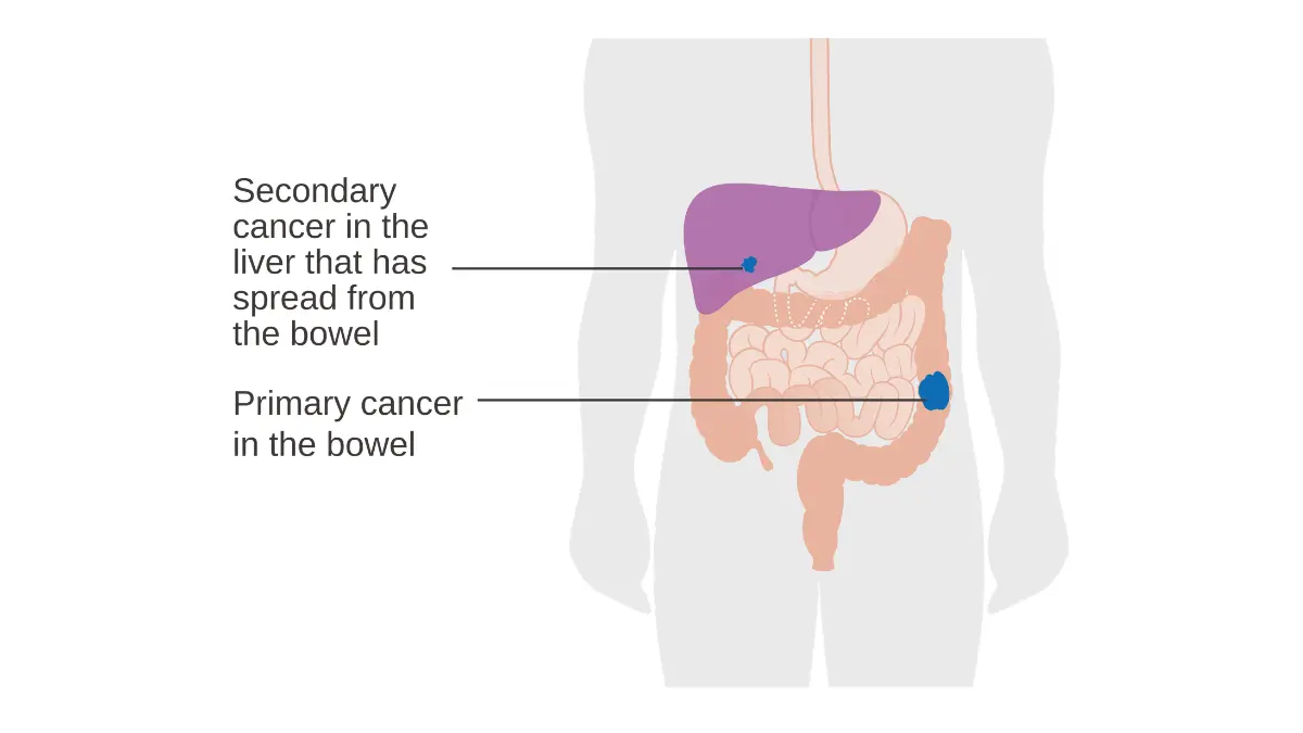 Primary and secondary cancer diagram explaining distant stage prostate cancer survival rate
