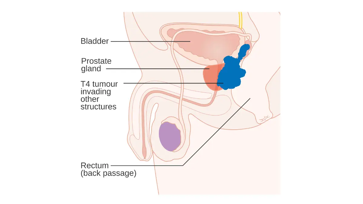 Stage T4 prostate cancer diagram showing distant spread for prostate cancer survival rate