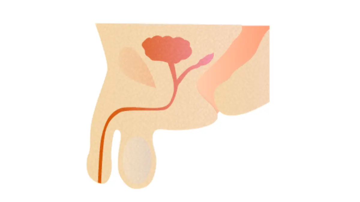 Prostate Cancer Under 50 educational icon highlighting the prostate gland in the male pelvis.