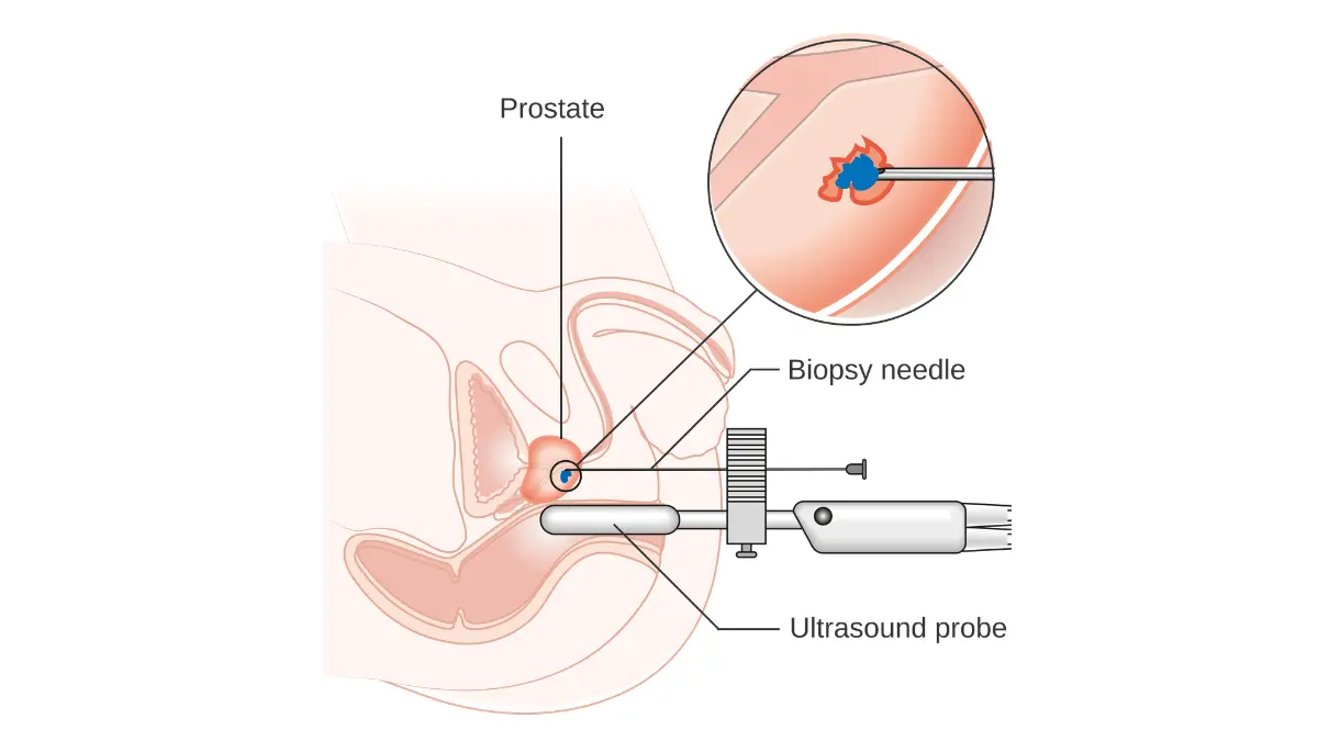 PSA Test illustration showing a transperineal prostate biopsy procedure