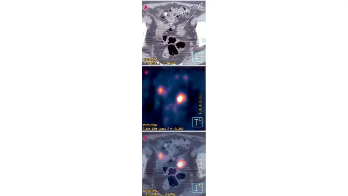 PSMA PET scan PET CT imaging example showing highlighted areas on medical scan