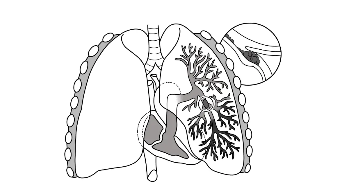 Pulmonary embolism blood clot blocking a pulmonary artery in the lungs, medical illustration.
