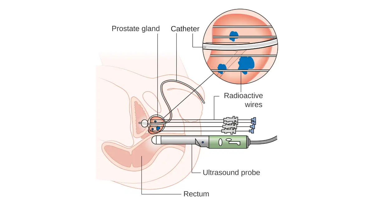 Diagram of high-dose-rate brachytherapy Radiation therapy showing catheters placed into the prostate to deliver internal radiation.