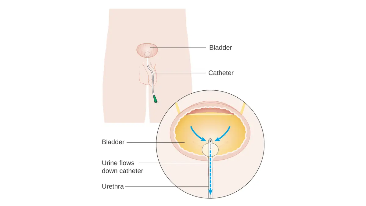 radical prostatectomy recovery illustration showing a urinary catheter in place after the prostate has been removed.