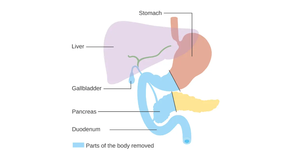 Resectable pancreatic cancer diagram showing the gastrointestinal parts removed during a Whipple operation.