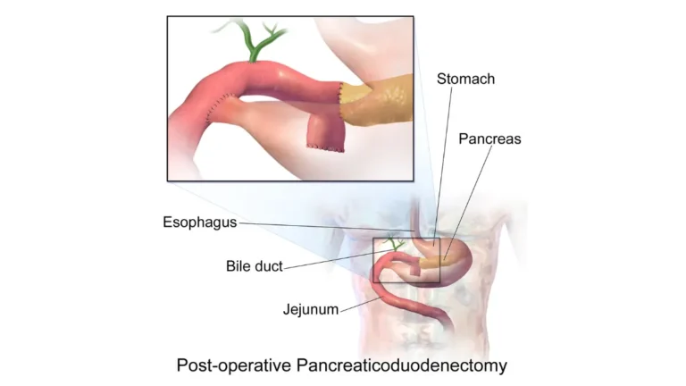 Resectable pancreatic cancer Whipple procedure showing organs removed during surgery.