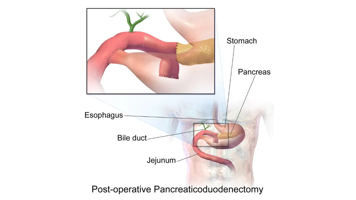 Resectable pancreatic cancer Whipple procedure showing organs removed during surgery.