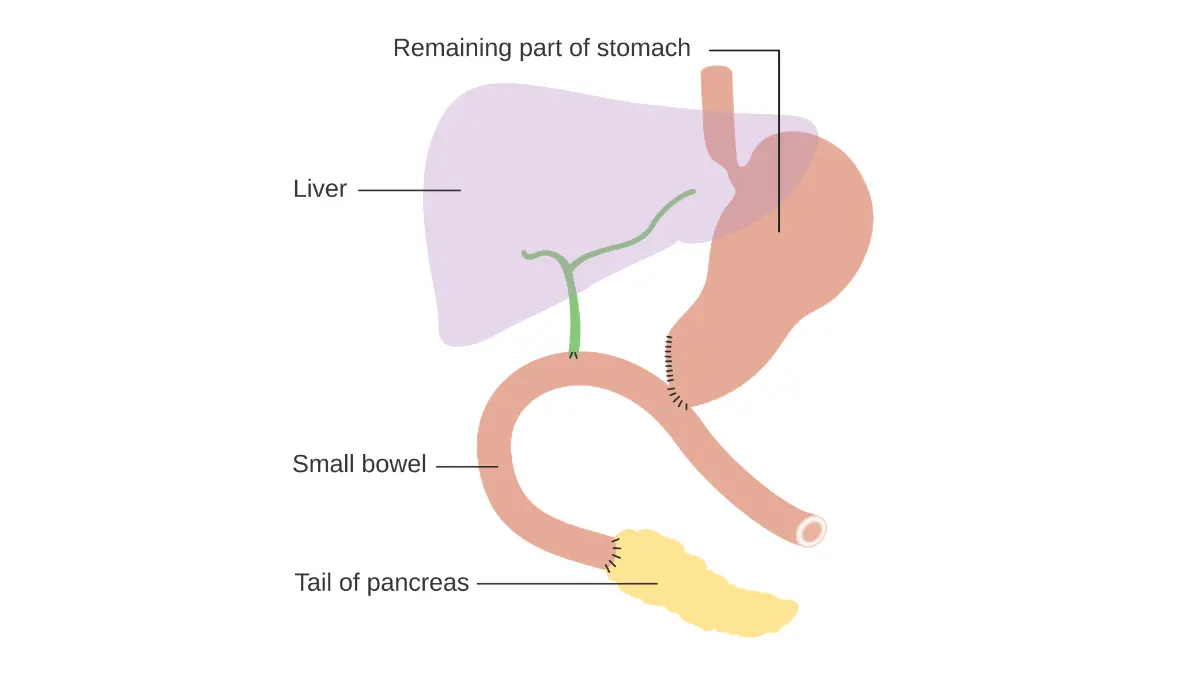 Resectable pancreatic cancer surgical reconstruction showing how the pancreas and bowel are rejoined after a Whipple operation.